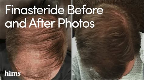 Finasteride Results: How Does Finasteride Work .